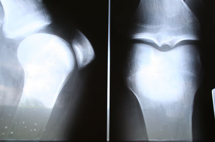Hiperparatireoidismo: tipos, definição, causas, sintomas, diagnóstico, tratamento e prevenção