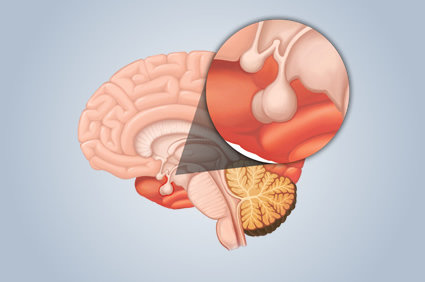 Hiperprolactinemia: quando a prolactina alta &eacute; motivo de preocupa&ccedil;&atilde;o?