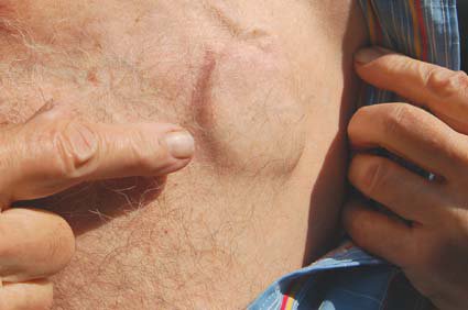 Marcapasso: como ele funciona? Quando é necessário?