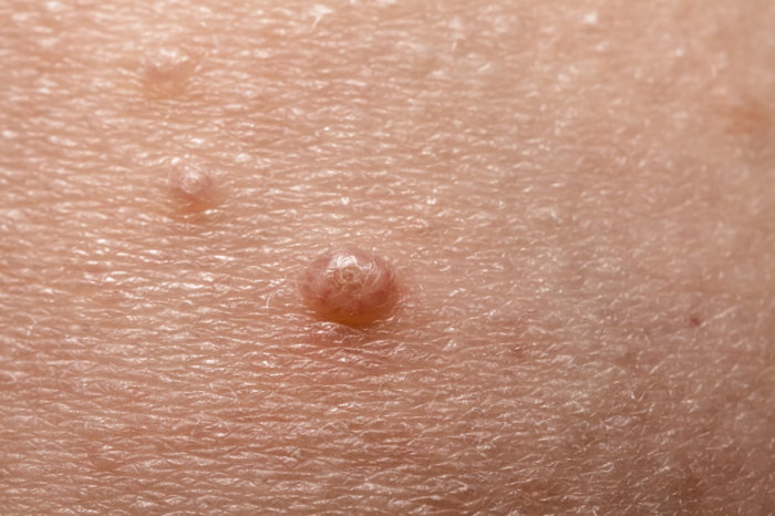 Molusco contagioso - conheça essa infecção de pele
