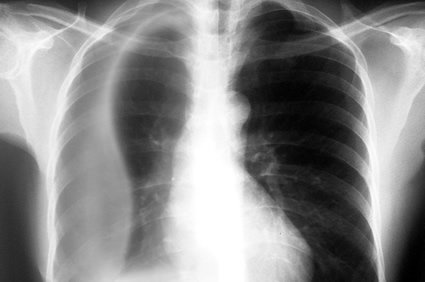 Pneumocistose: uma infecção oportunista que pode causar problemas em imunocomprometidos