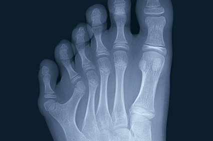 Polidactilia Definicao Tipos Causas Sinais E Sintomas Diagnostico E Tratamento Ortopedia E Saude Abcmed
