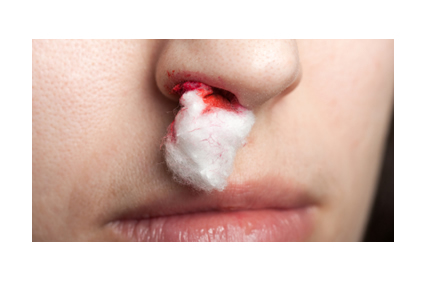 Sangramento nasal ou epistaxe: quais são as causas? O que se deve fazer? O  que não fazer quando o nariz sangra? E após o sangramento? - AbcMed