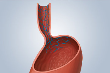 Varizes esofágicas: o que são? Quais as causas? Como são o diagnóstico e o tratamento? Como evoluem? Tem jeito de evitar?
