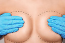 Rippling da mama: ondulações nas laterais das mamas