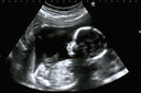 Ecocardiograma fetal