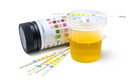 Exame de urina: elementos e sedimentos anormais (EAS)