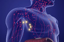 Linfoma de Hodgkin: uma neoplasia com elevado potencial de cura