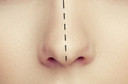 Rinoplastia ou plástica no nariz: o que é? Quando fazer? Como é? O que fazer no pós-operatório?