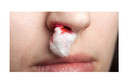 Sangramento nasal ou epistaxe: quais são as causas? O que se deve fazer? O que não fazer quando o nariz sangra? E após o sangramento?