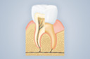 Tratamento de canal dentário: quando fazer? Em que consiste?
