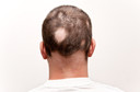 Você sabe o que é alopecia areata?